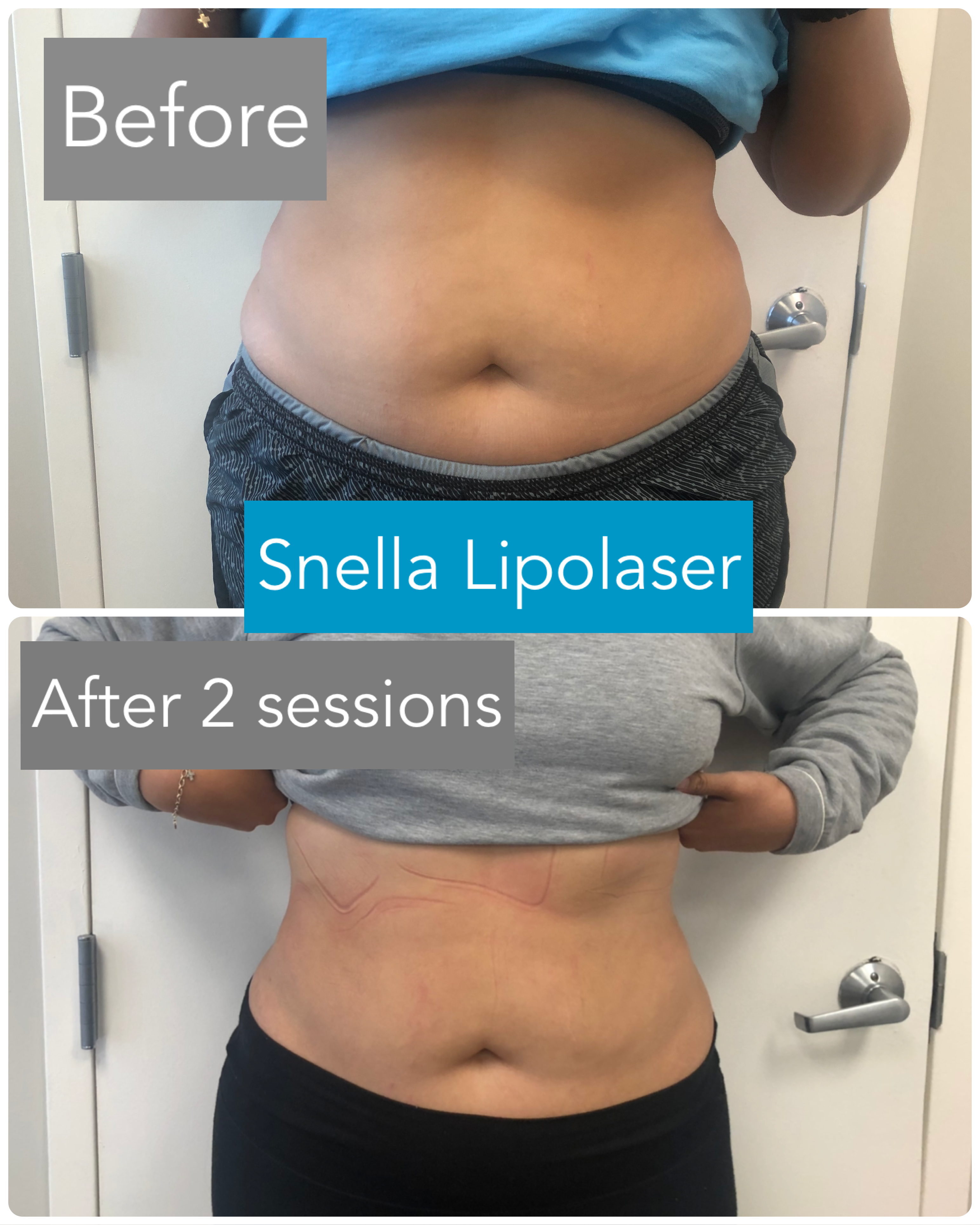 Snella Lipo Body Contouring Slimming & Fat Reduction