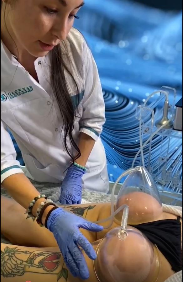 Curv Vacuum and Cupping Therapy